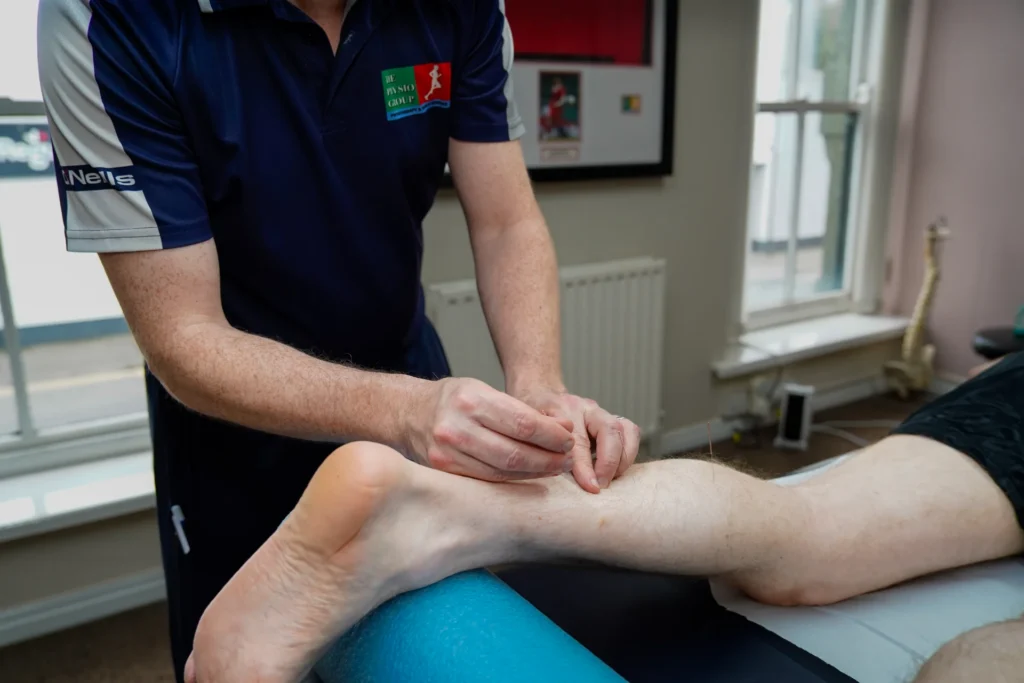 Acupuncture